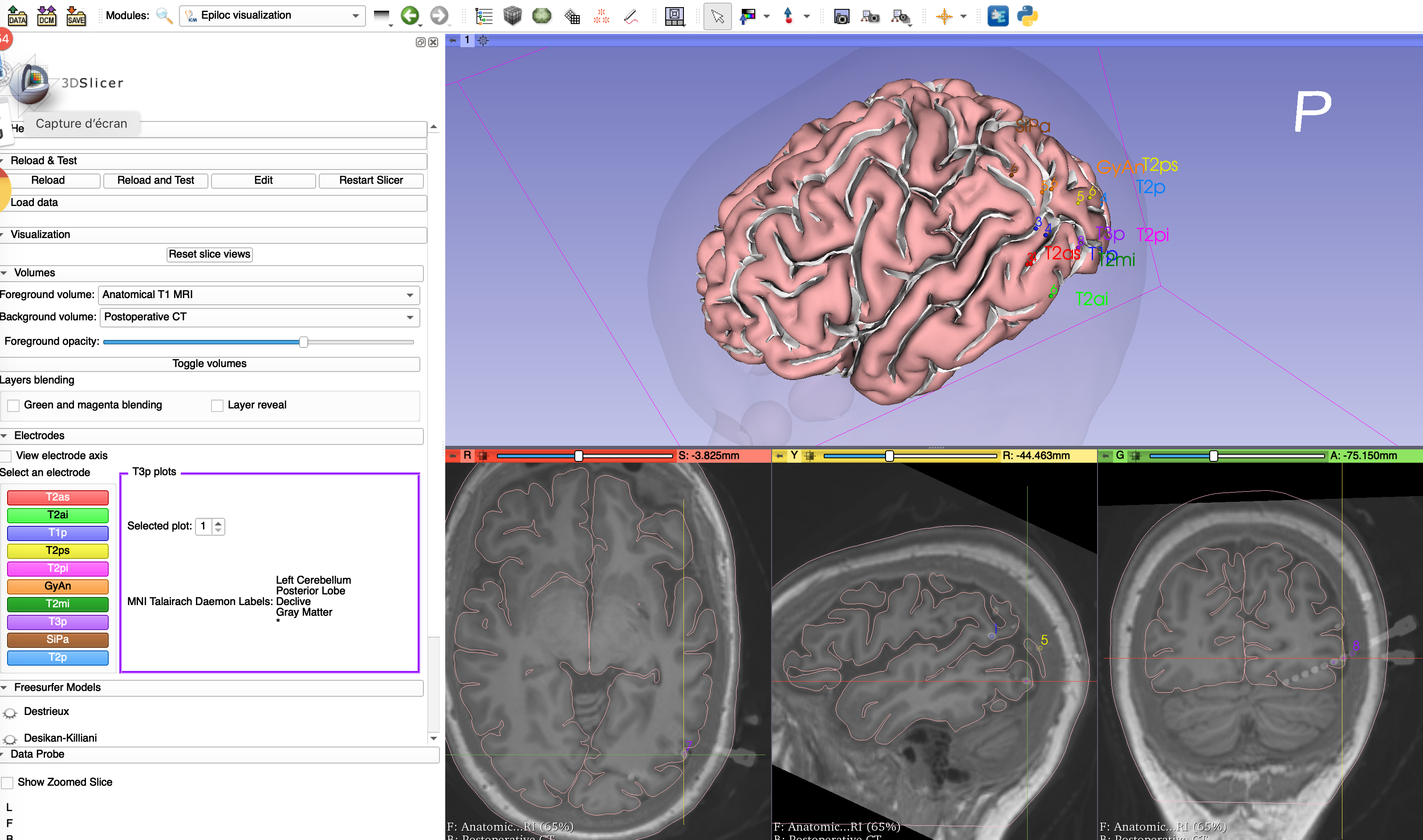 EpiLoc-View in 3D Slicer 4.11 - 2